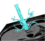 Robust segmentation of anatomical structures with deformable surfaces and marching cubes